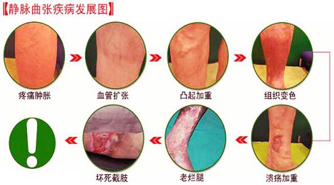 腿部静脉曲张的治疗方法 优先选择健康有效的修复方法