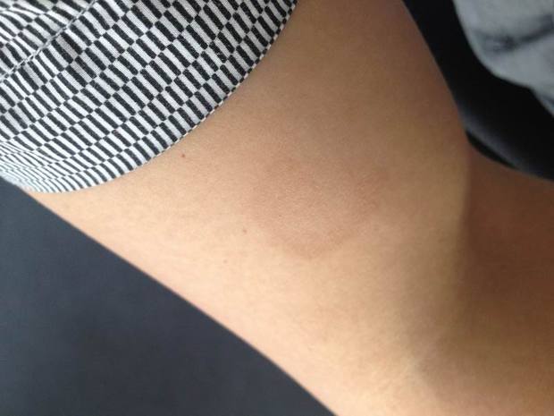 离心性红斑怎么治?