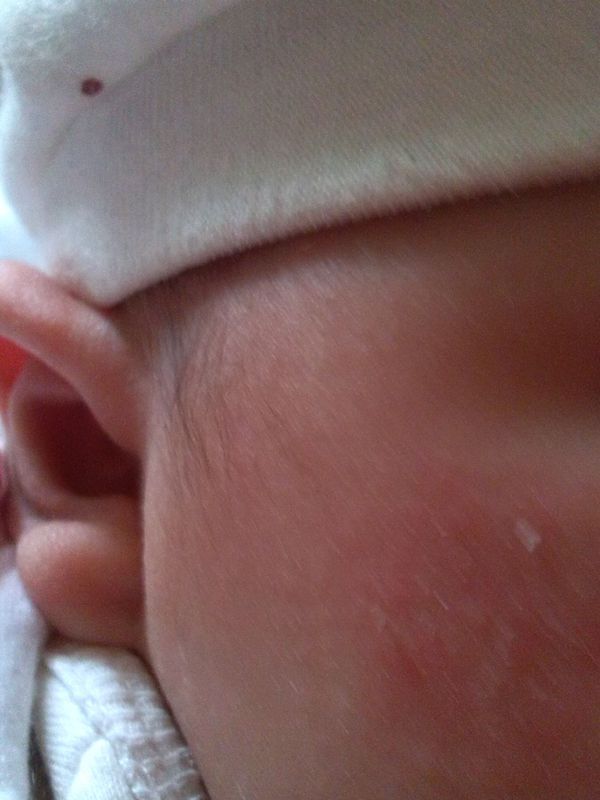 宝宝脸上长了红色的小疙瘩,在一个月前宝宝脸