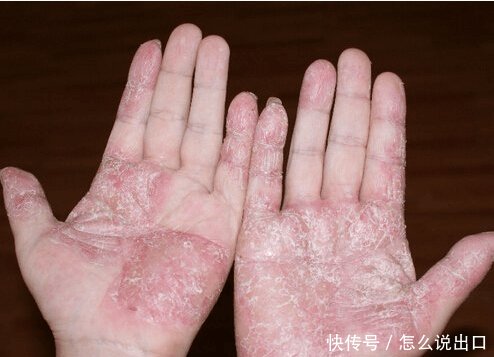 手脱皮是怎么回事 如何缓解和预防 (含治疗偏方