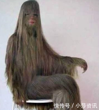 妙龄少女全身长满了毛，在医生的治疗下去掉长毛后，让人眼前一亮