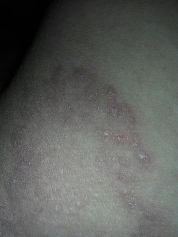 来帮帮,我朋友他最近阴部里长了许多小痘痘样