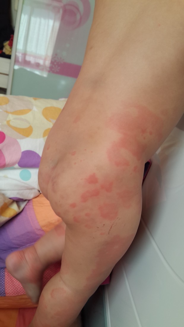 一岁半幼儿皮肤过敏去小门诊看了说是荨麻疹全身几乎