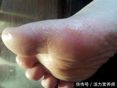 脚上磨出了很多的小水泡,自己要不要挑破?看看