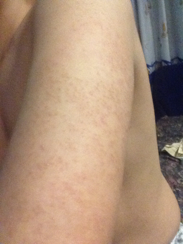 我的胳膊上有好多小红斑点,也有一些小疙瘩,都