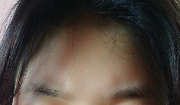 请问大家最近几个月为什么眉骨突出,额头中间