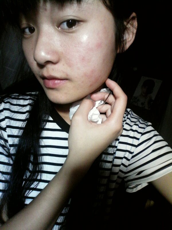 脸不知道怎么了,一块一块红的,还很痒。皮肤很