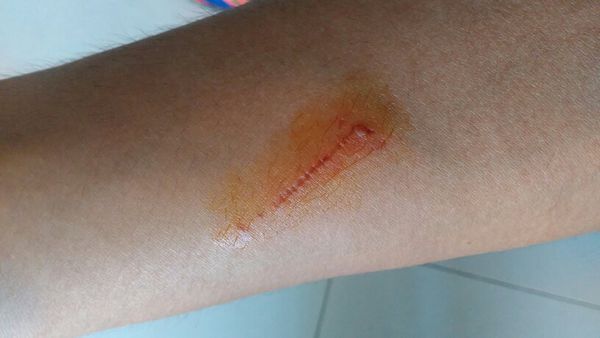 会留下疤吗? 打篮球被别人指甲抓伤了~好心人