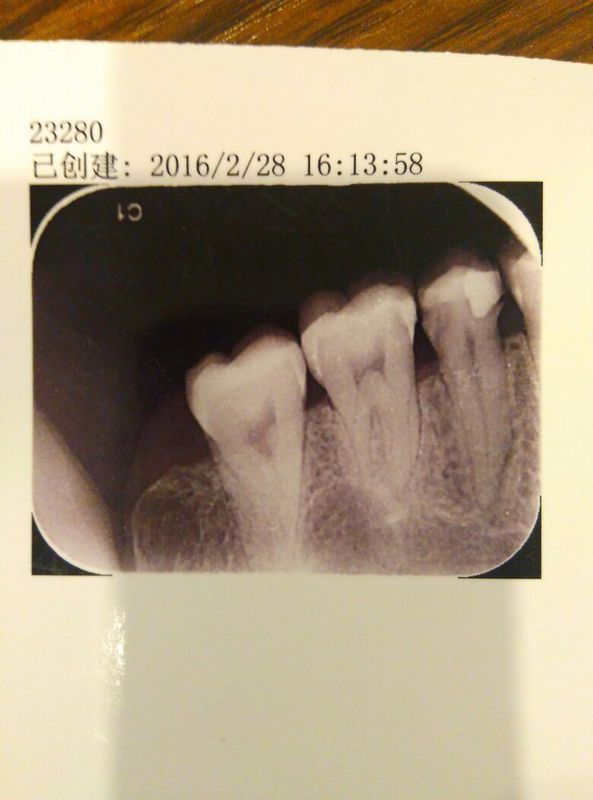 去医院照了牙片,医生说要做根管治疗,我不想做