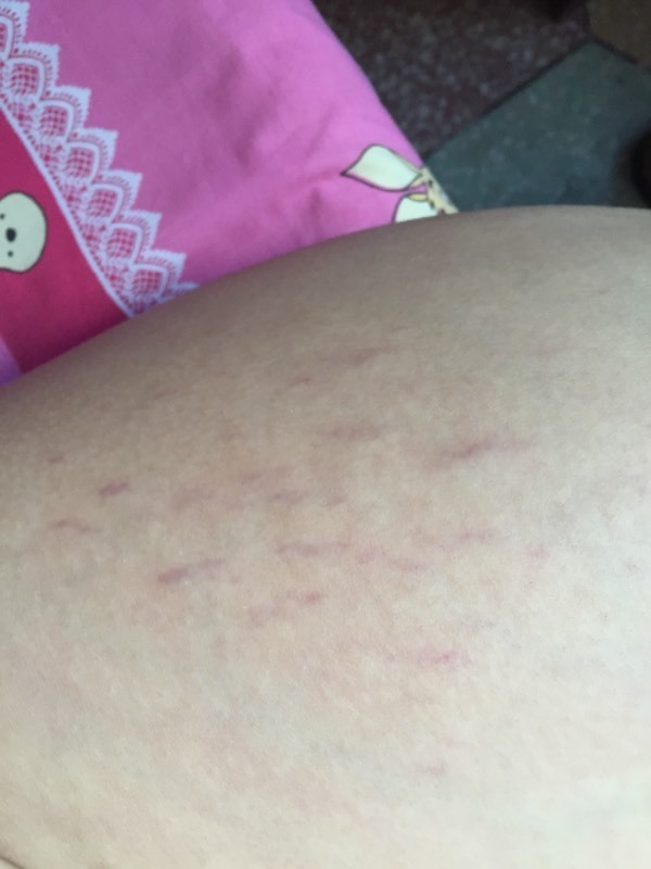 大腿上有紫红色的条纹,很多,这是皮肤病?还是