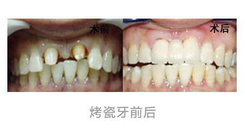 以前补的牙齿填充物脱了了,看后医生建议打立