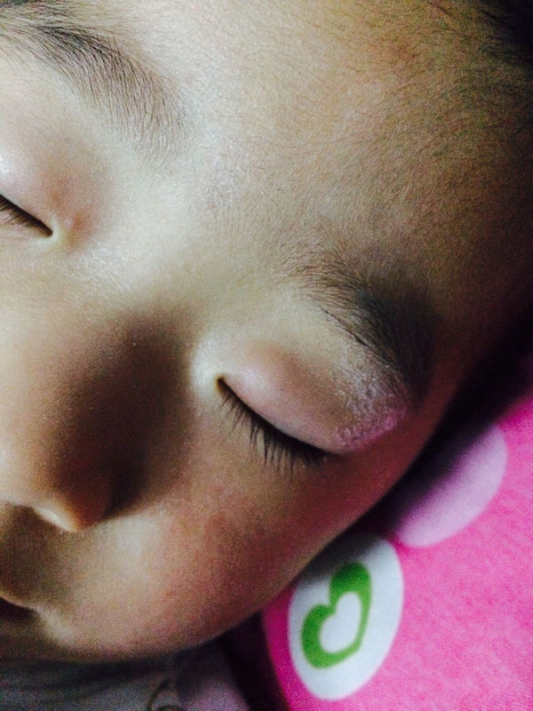 宝宝得了霰粒肿,上眼皮,刚开始不知道,以为是蚊