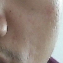 我的脸颊怎么凹陷了怎么办