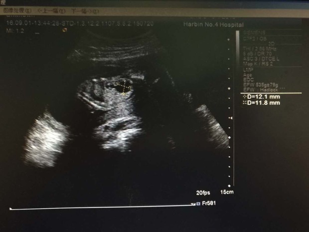 怀孕二十二周做大排畸胎儿左肾积水怎么办?左