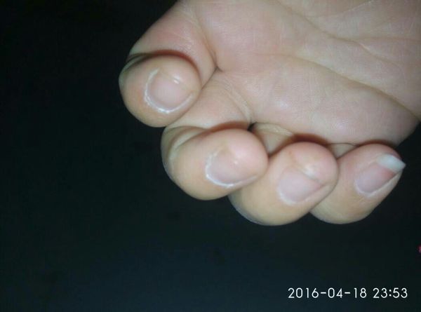 我的手一年四季都有倒刺,指甲两边有死皮,手指