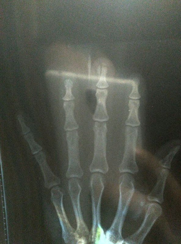 手指末端开放性骨折一个月了骨头没有愈合,伤