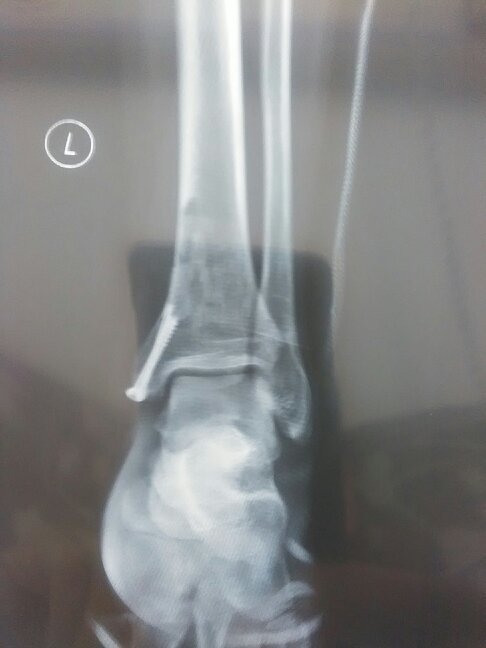左内踝骨折错位手术了,不知道手术做的怎么样