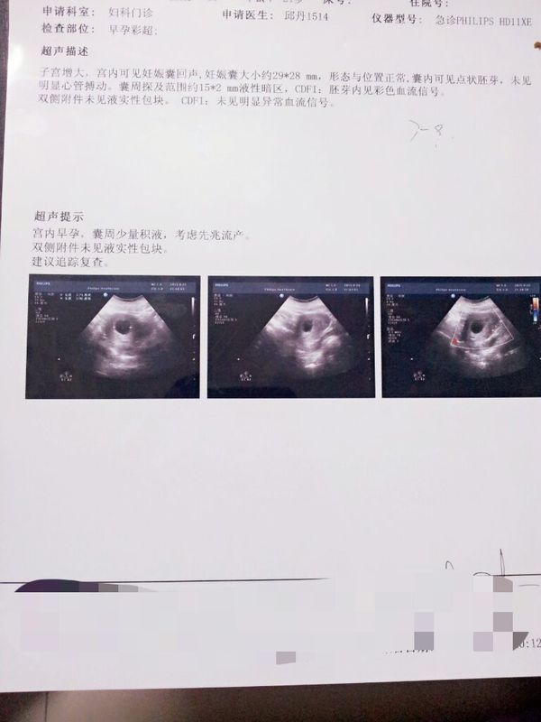 B超检查结果!怀孕50天,有胚芽,无胎心搏动,有痛
