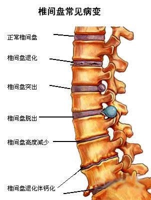 腰椎间盘轻度向后突出_360问答