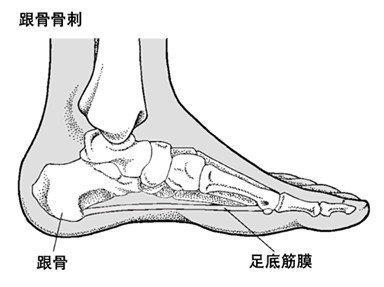 足跟骨刺即足跟骨质增生,其症状是足跟压痛, 走路时脚跟不敢用力,有石