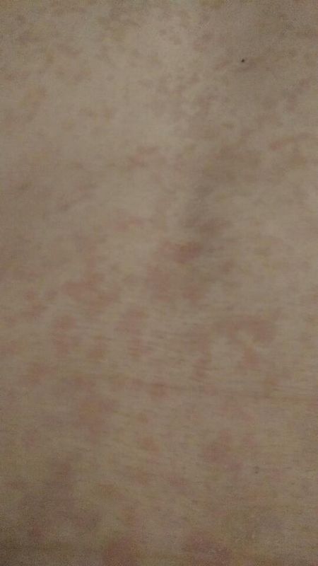 身上莫名出现这样的红疹,之前很少没在意,只有