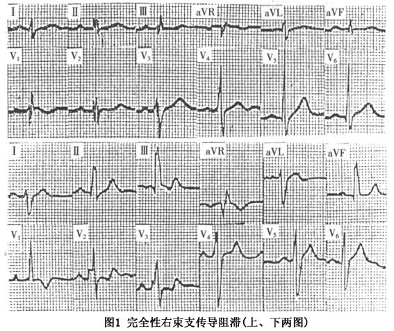 我做过心脏病手术,但是今天体检医生说是:窦性