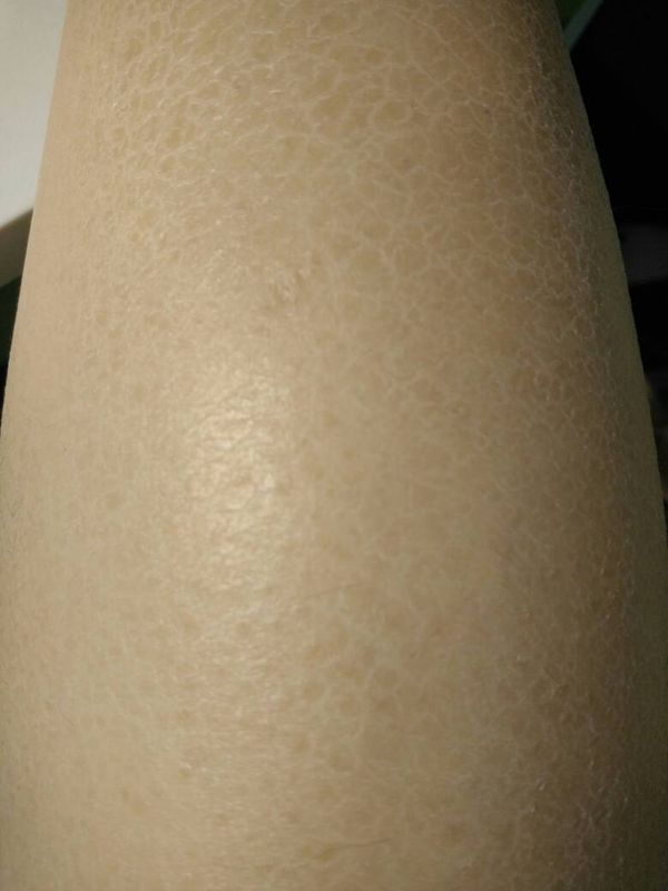 腿部皮肤一直如此,这是皮肤角质化的症状吗?该