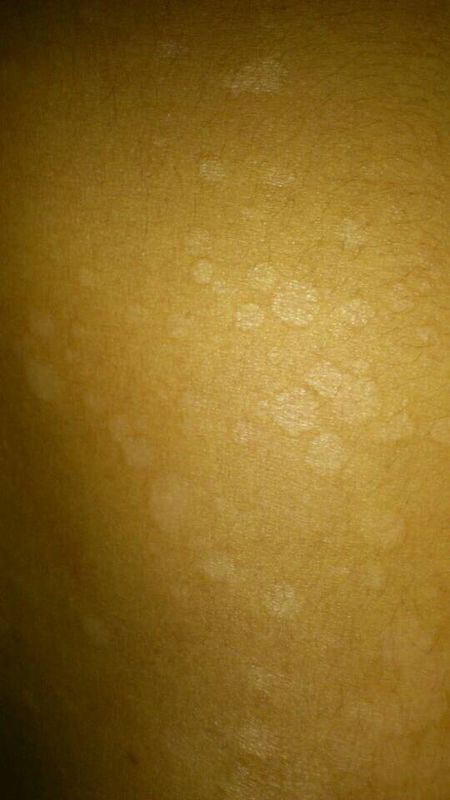 皮肤病 背部大片白色小斑点 是什么症状 怎么治