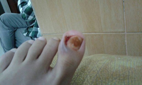 我脚拇指患了甲周炎,第一张图是我以前的拇指