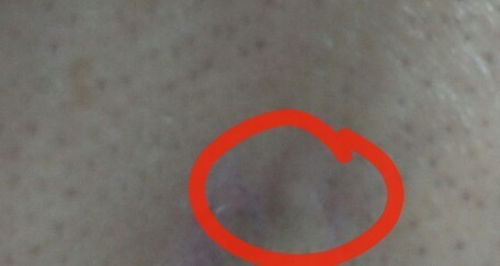 鼻子上有包好几年了是因为当年青春痘扣破了怎