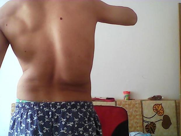 今年28岁后天脊椎弯曲右突畸形因家里困难一