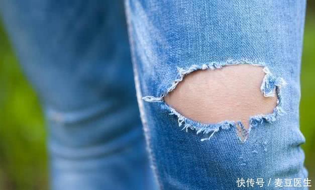 脚肿了别不当回事,小心蛋白尿和肾病综合征