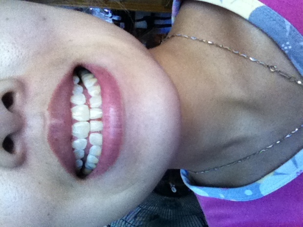 牙齿矫正完又反弹了+带保持器还有用吗?