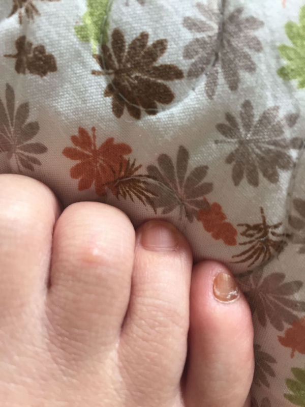 脚上长了四颗小水泡,特别痒,就像是蚊子叮的,但