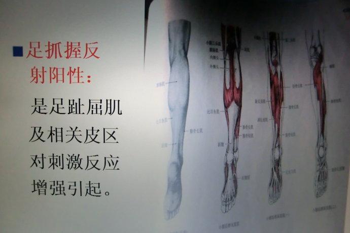 脑瘫反射异常新解及干预1