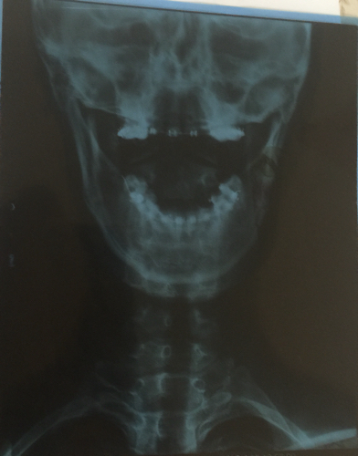 帮我解释下这个颈椎片子 哪有问题该怎么办?颈