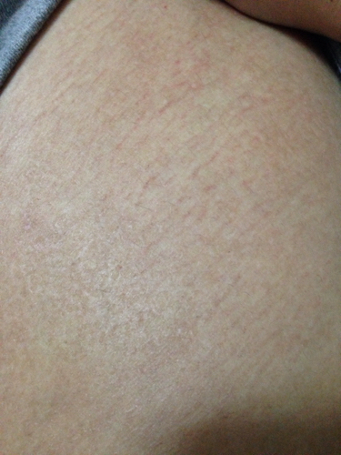 求解:腿上有一块皮肤,以前有红点,很痒,后来用咪