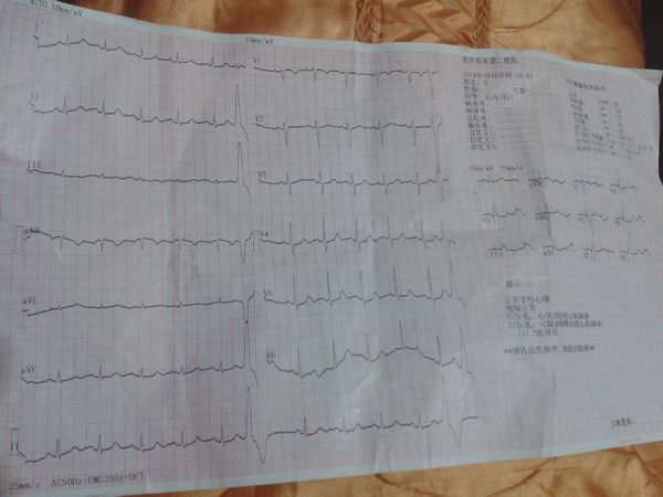 60岁 心脏早搏,心肌缺血 这是心电图 求详细给