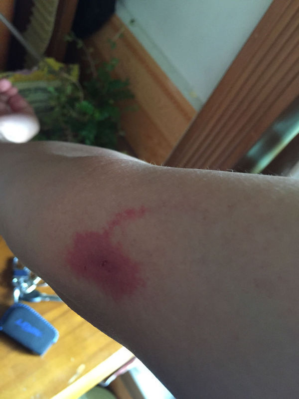 能用什么擦,被什么蚊虫咬到一样。_360问答