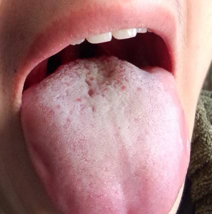 我舌头特别痛,一看!舌头发白舌苔特别厚,两边有