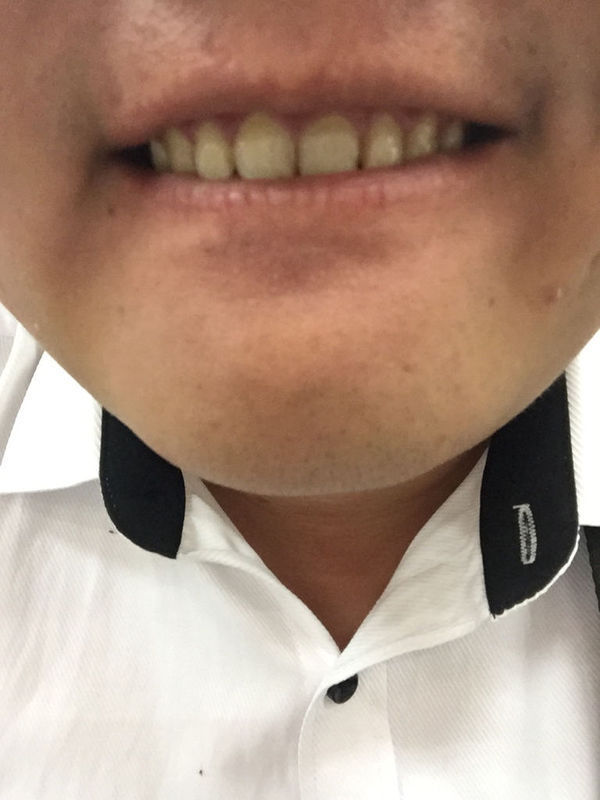 常年抽烟牙齿发黄发黑,用这东西一刷马上就把