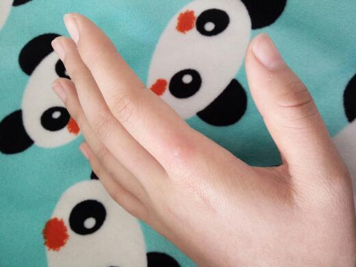 手冻了,起泡了怎么办?以前从来没冻过_360问答