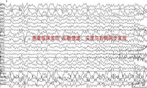 但有时临床发作已基本控制而脑电图仍有异常,这不并意味着一定要继续