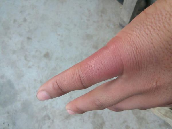 热盐水是怎么治疗冻手,直接把盐放到热水里泡