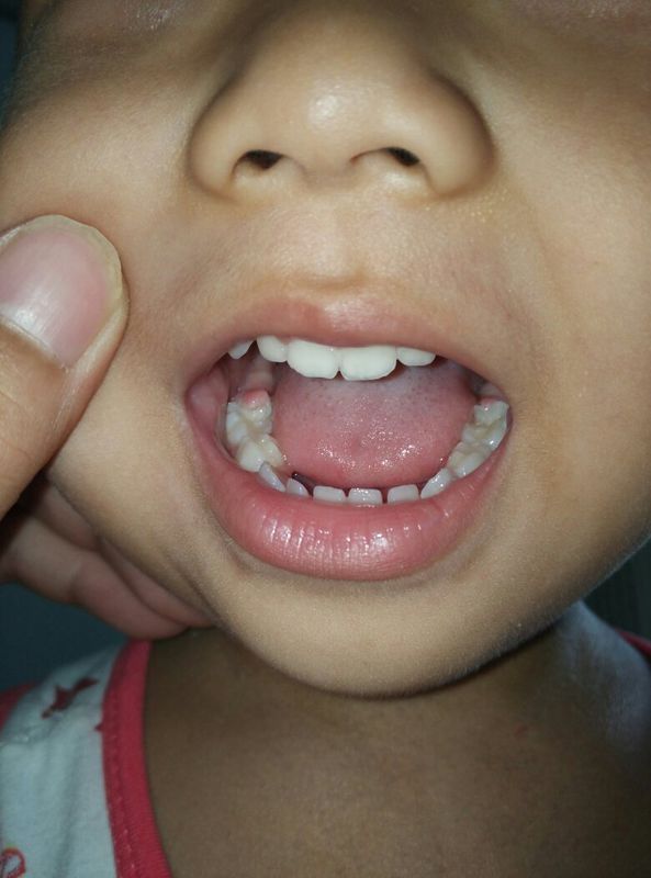 孩子嘴里下颚槽牙长了小肉豆子、如图、请问那