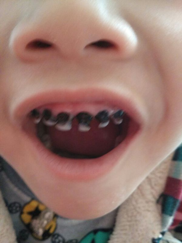 四岁幼儿牙齿现在越来越黑了怎么办?上排的全