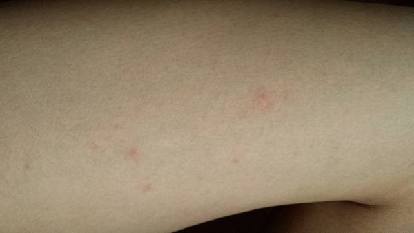 皮肤上一直长小红点,大腿上居多,上身较少,指缝里有一个两个又消失_360问答