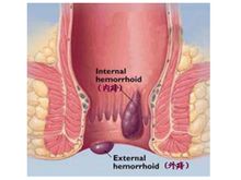 静脉曲张性外痔d.混合痔的内痔部分e.内.