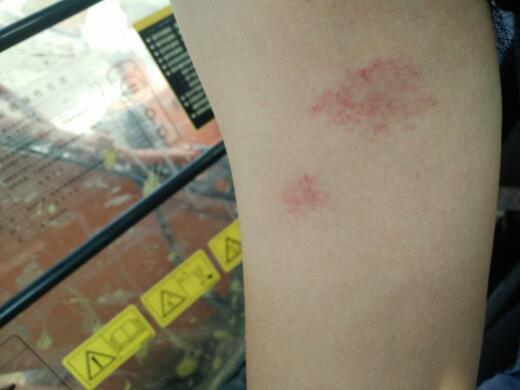 这是什么情况 是皮肤病 还是被什么虫子咬了 我