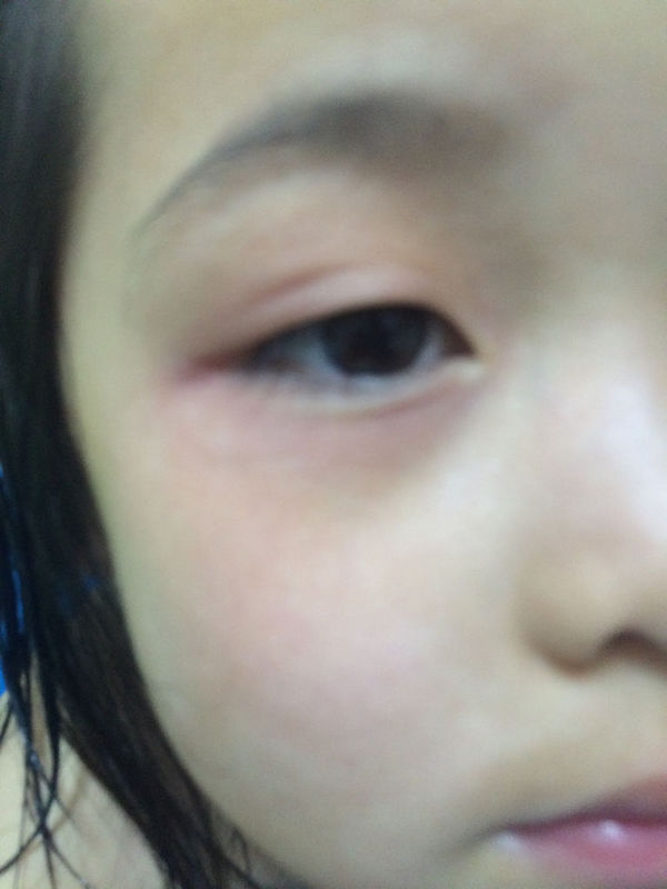 五岁孩子眼睛四周发红是什么原因? 之前感冒了